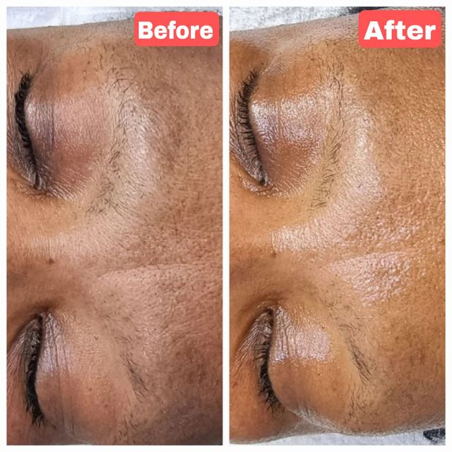 Peeling Melanostop